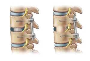 TLIF Surgery